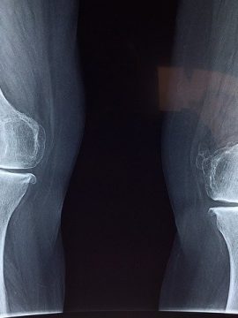 תאונות עבודה בחו"ל: כיצד ניתן לקבל פיצויים?